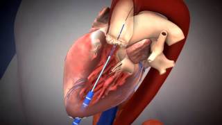 SAPIEN TAVR Deployment Using Transapical Approach [upl. by Wrand]