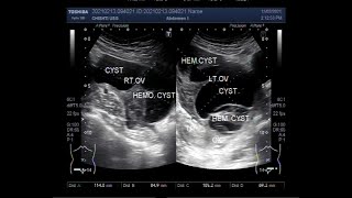 Bilateral Multiple Ovarian Cysts and Ovarian Mass [upl. by Atlante318]