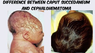 Difference between caput succedaneun and cephalohematoma [upl. by Etteyniv]