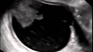 Ultrasound in Obstetrics amp Gynecology A Practical Approach  Clip 122 [upl. by Riek]