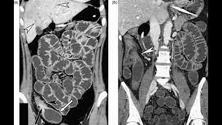 CT Enteroclysis Procedure [upl. by Ardnajela25]