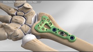 Distal Radius Fracture Repair  Volar Plate [upl. by Eidnam]