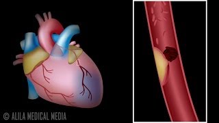 InferiorPosterior and Lateral Myocardial Infarction [upl. by Catriona]