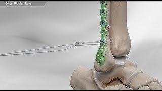 Distal Fibular Plate [upl. by Mufinella503]