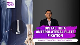 Distal Tibia Anterolateral Locking Plate Fixation Procedure [upl. by Elene]