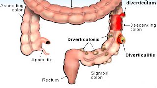 Diverticulitis [upl. by Darrel]