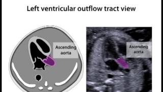 The Fetal HeartThe Transverse Sweep [upl. by Buiron649]