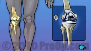 Knee Replacement Surgery PreOp® Patient Education [upl. by Ahc645]