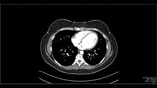 Abdominal Anatomy on Computed Tomography [upl. by Ahsyla]