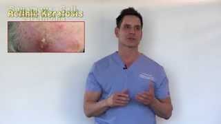 PreCancers or Actinic Keratosis Treatment Options With Dr Timothy Jochen [upl. by Aerdnek]