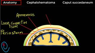 Cephalohematoma versus Caput succedaneum [upl. by Sucul]