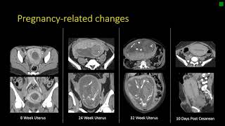 Gynecologic Radiology Anatomy [upl. by Annol]