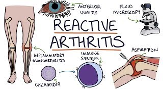 Understanding Reactive Arthritis [upl. by Newby]