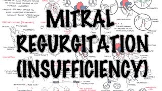 Mitral Reguritation insufficiency  Overview signs and symptoms pathophysiology treatment [upl. by Charin]