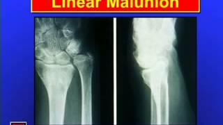 Distal Radius Fractures [upl. by Bechler]