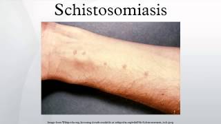 Schistosomiasis [upl. by Yeh]