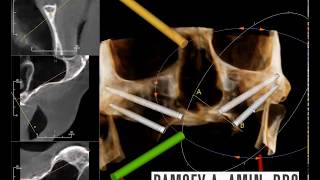 Zygomatic Immediate Load Dental Implant Planning [upl. by Yelwah645]